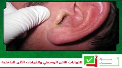 التهابات الأذن الوسطي والتهابات الأذن الداخلية