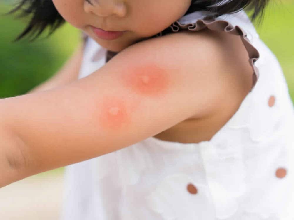 حساسية الجلد للأطفال الرضع